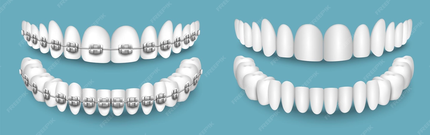 Invisalign vs. Traditional Braces