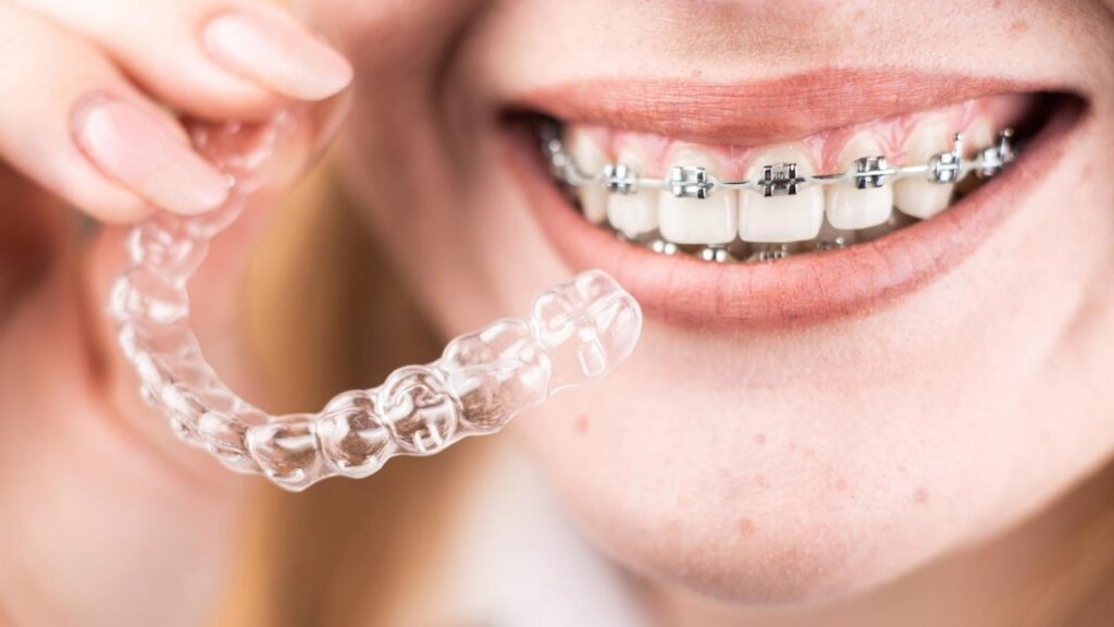Invisalign