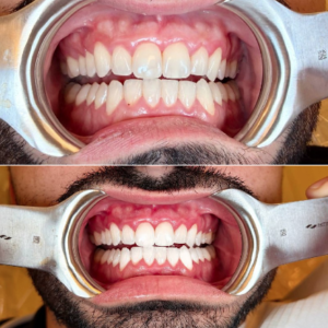 Zoom whitening