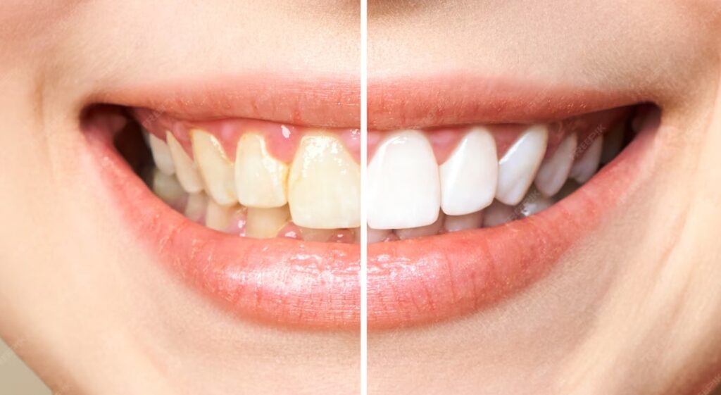 Before After whitening teeth