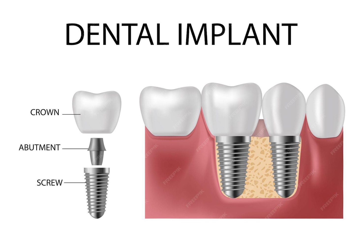 Dental Implants in Laguna Niguel