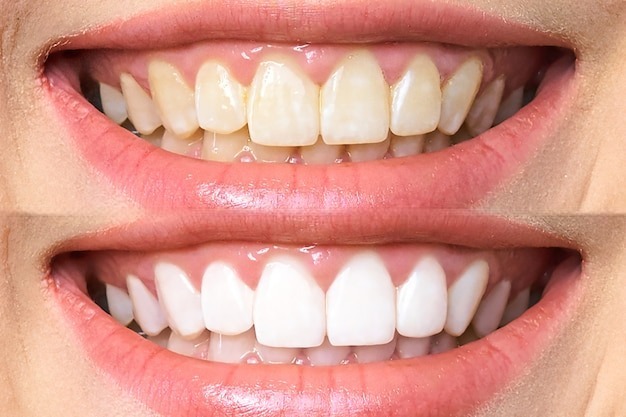 Teeth Whitening Laguna Niguel