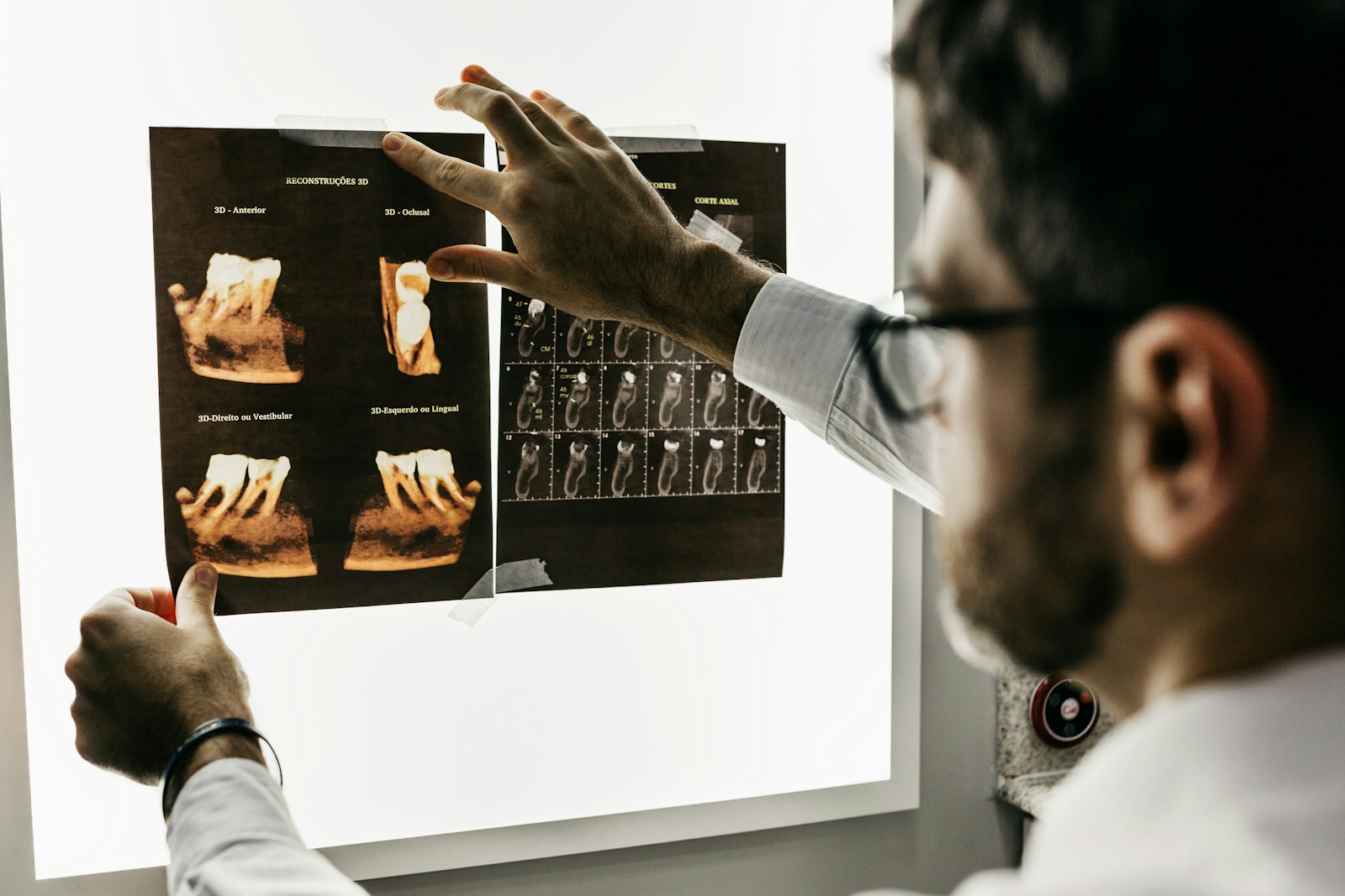 Dental X-ray showing implant placement planning for a patient at Laguna Niguel Dental